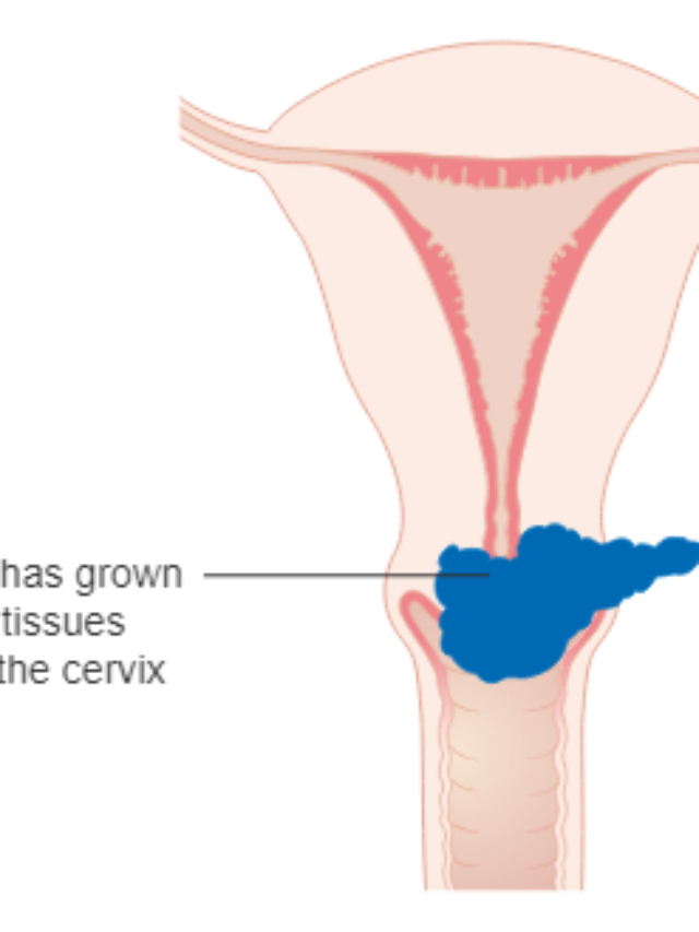 some-cervical-cancer-patients-benefit-from-simpler-hysterectomy-hill